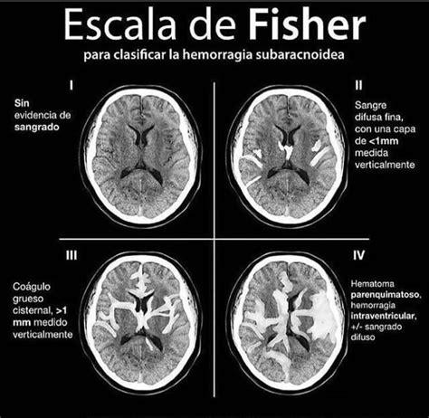 infarto cerebral agudo